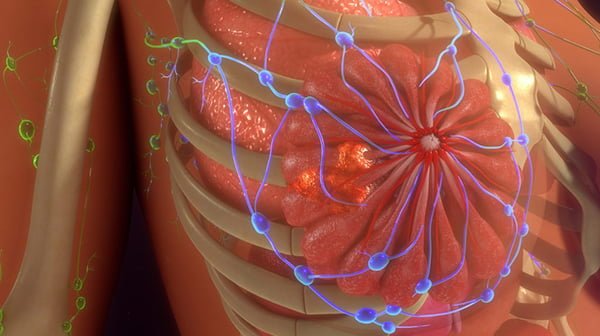 her-2 é o tumor mais comum diagnosticado em mulheres com câncer de mama