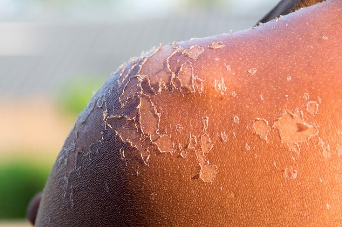 O câncer de pele é um dos tipos da doença com maior incidência no Amazonas