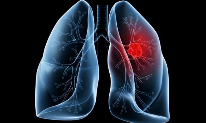 Agosto Branco: Precisamos falar sobre câncer de pulmão