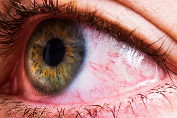 Existe mais de um tipo de câncer nos olhos que podem surgir. Descubra os mais comuns!