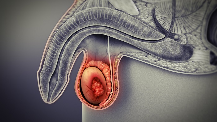 o nódulo pode surgir em um ou nos dois testiculos e possui o tamanho de uma ervilha