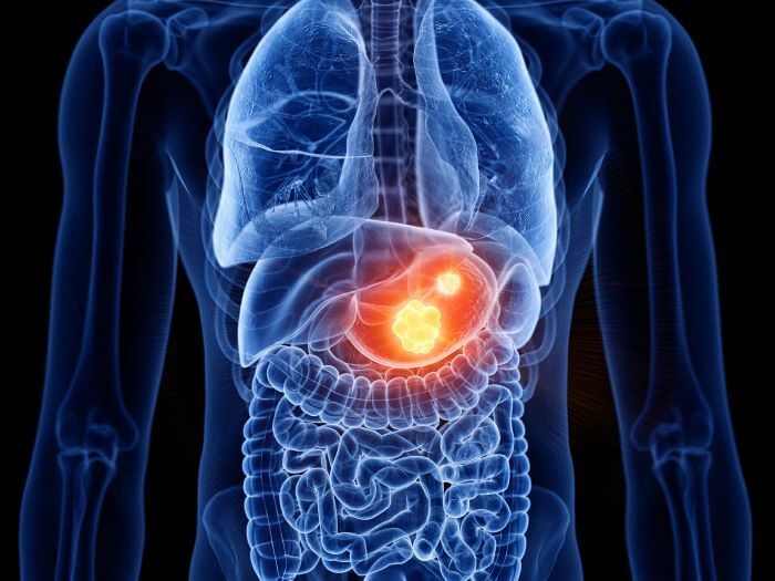 Tumor Gastrointestinal também é uma das causas de dores no estômago, veja aqui quais outros motivos desse incômodo